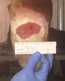 Diabetic Foot Ulcer treated with Total Contact Cast